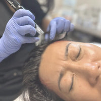 Microneedling